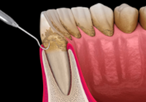 ルートプレーニング （歯肉縁下の歯石除去）