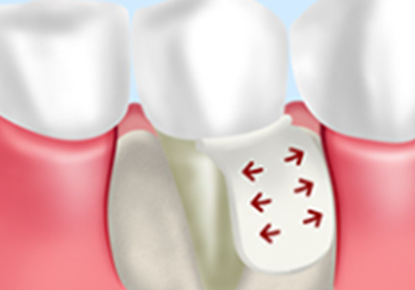 GTR法（歯周組織再生療法）
