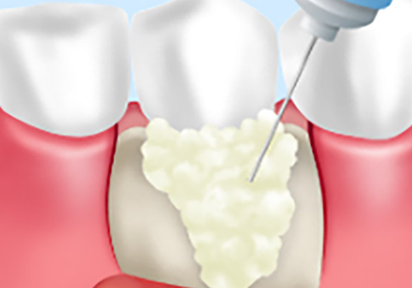 エムドゲイン法 （歯周組織再生療法）